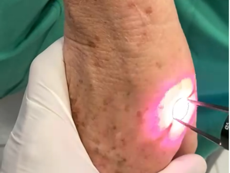Laser Para Tratamento De Manchas Escuras Na Pele Hipercromias Dr